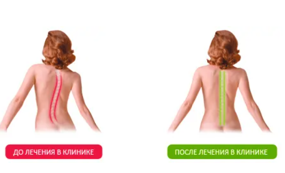 Остеохондроз симптомы и лечение у женщин Город Москва